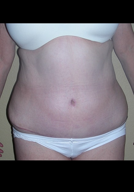 Tummy Tuck Before & After