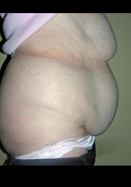 Tummy Tuck Before & After