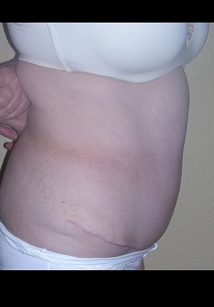 Tummy Tuck Before & After