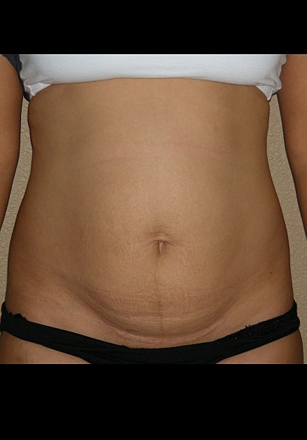 Tummy Tuck Before & After
