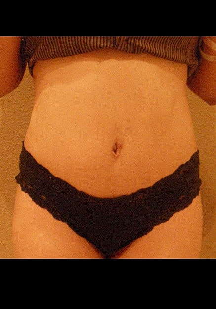 Tummy Tuck Before & After