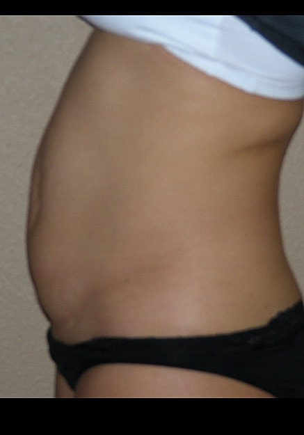 Tummy Tuck Before & After
