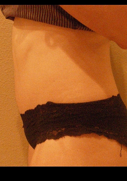 Tummy Tuck Before & After