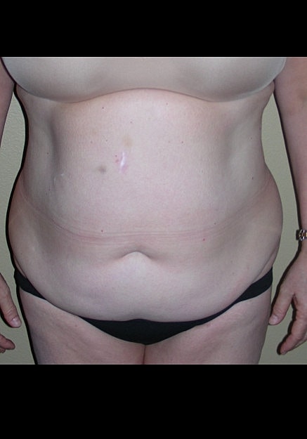 Tummy Tuck Before & After