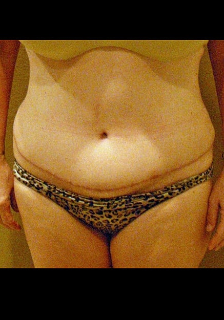 Tummy Tuck Before & After
