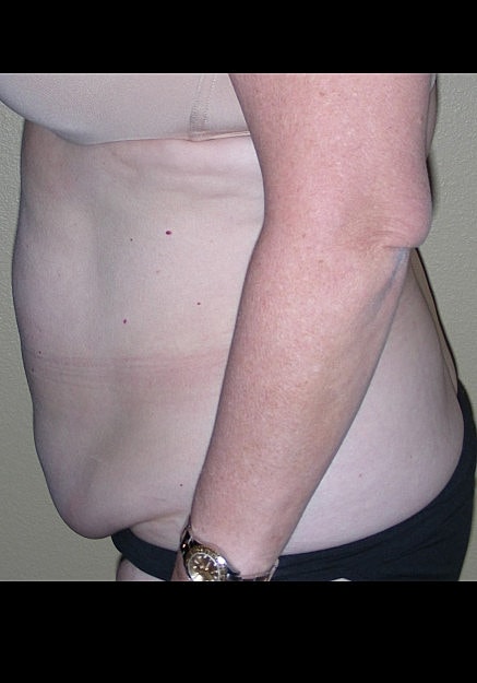 Tummy Tuck Before & After