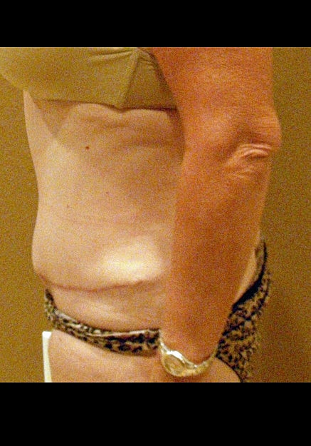 Tummy Tuck Before & After