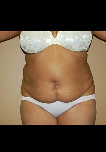 Tummy Tuck Before & After