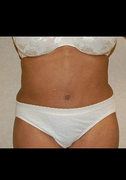 Tummy Tuck Before & After