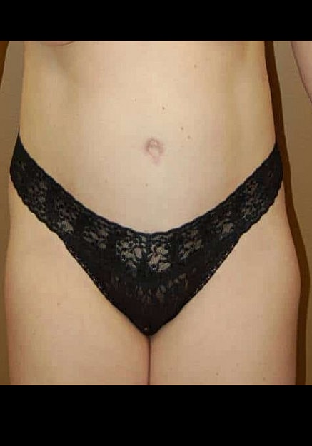 Tummy Tuck Before & After