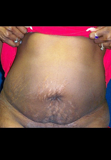 Tummy Tuck Before & After