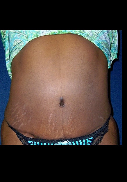 Tummy Tuck Before & After