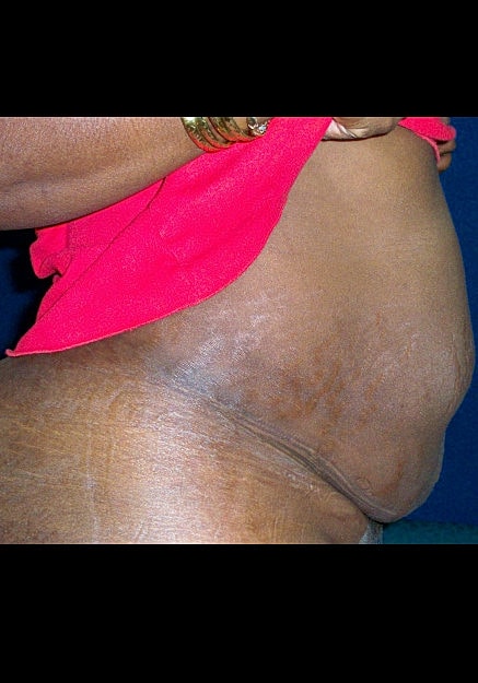 Tummy Tuck Before & After