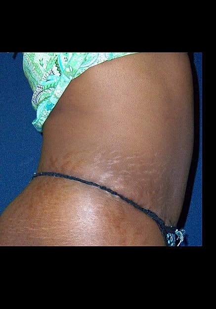 Tummy Tuck Before & After