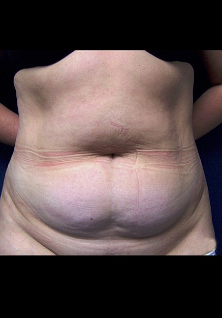 Tummy Tuck Before & After