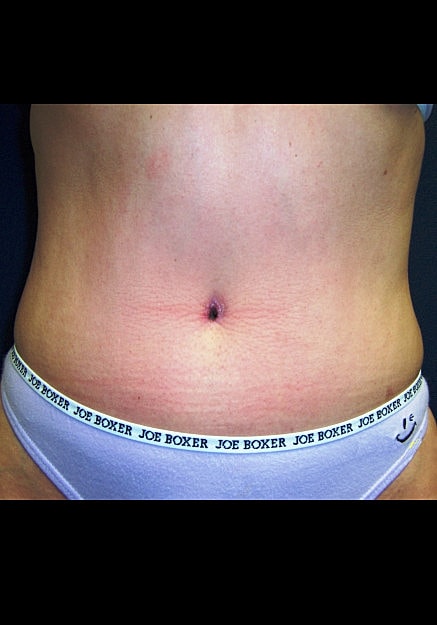 Tummy Tuck Before & After