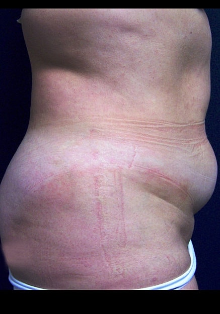 Tummy Tuck Before & After