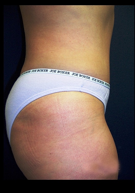 Tummy Tuck Before & After