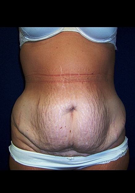 Tummy Tuck Before & After