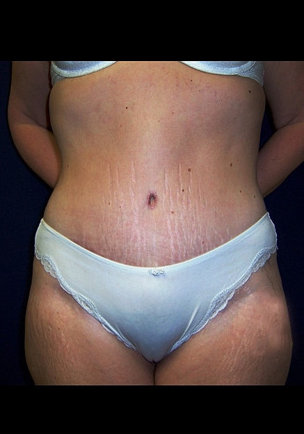 Tummy Tuck Before & After