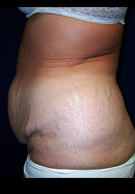Tummy Tuck Before & After