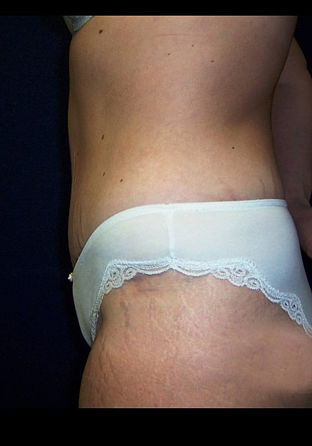 Tummy Tuck Before & After