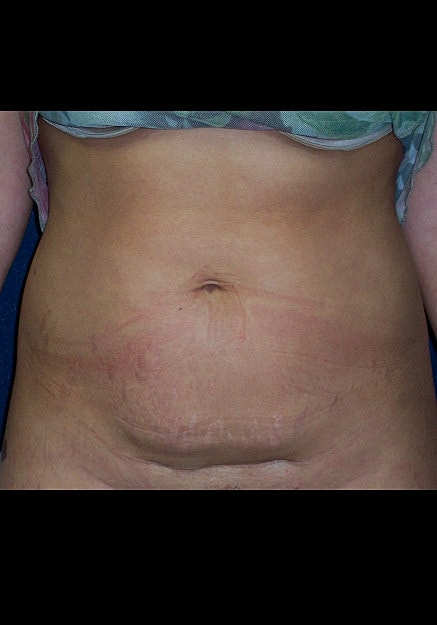 Tummy Tuck Before & After