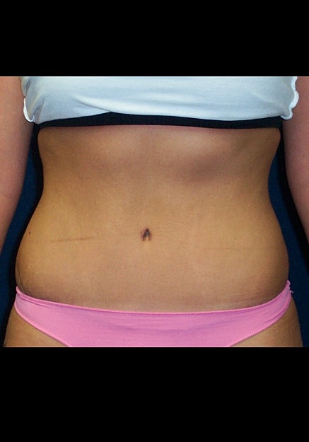 Tummy Tuck Before & After
