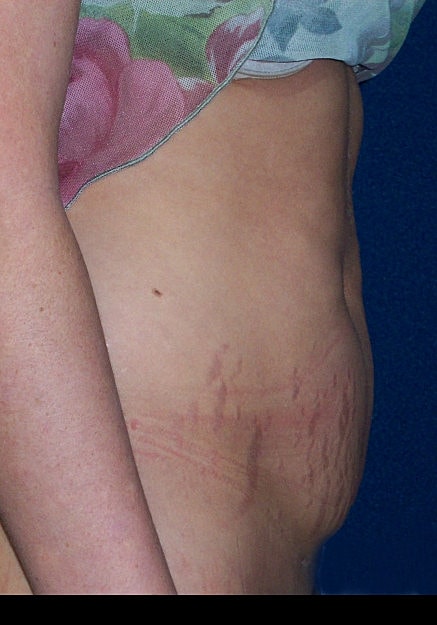 Tummy Tuck Before & After