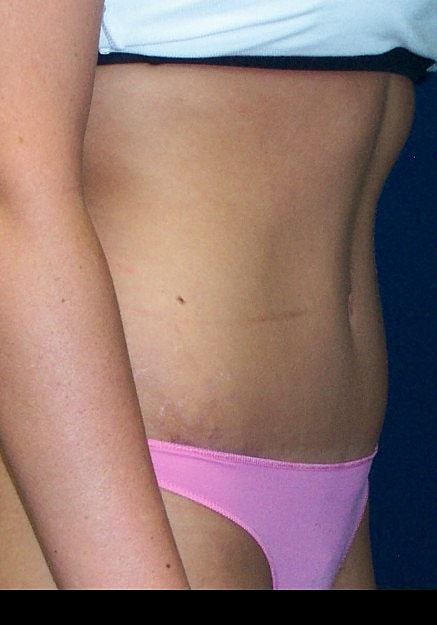 Tummy Tuck Before & After