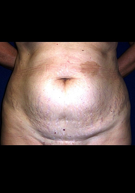 Tummy Tuck Before & After