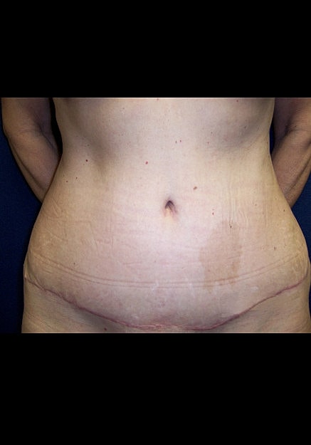 Tummy Tuck Before & After