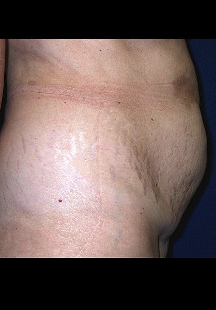 Tummy Tuck Before & After