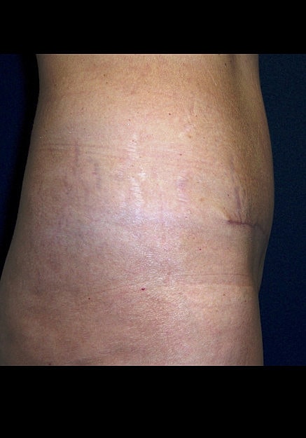 Tummy Tuck Before & After