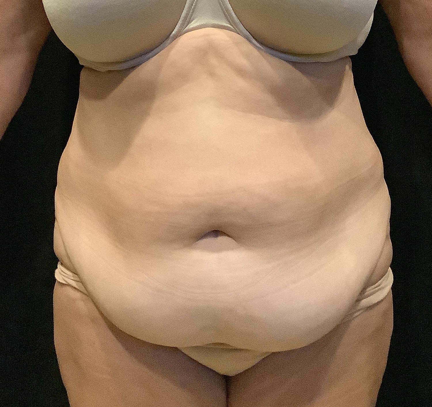 Tummy Tuck Before & After