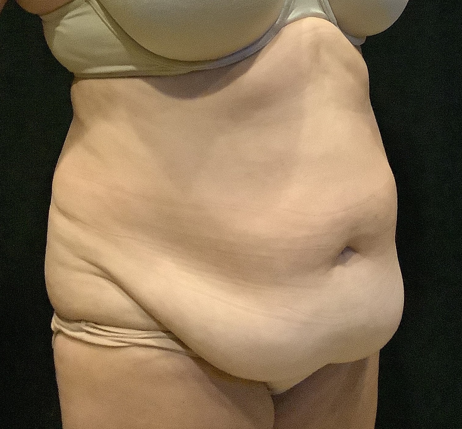 Tummy Tuck Before & After