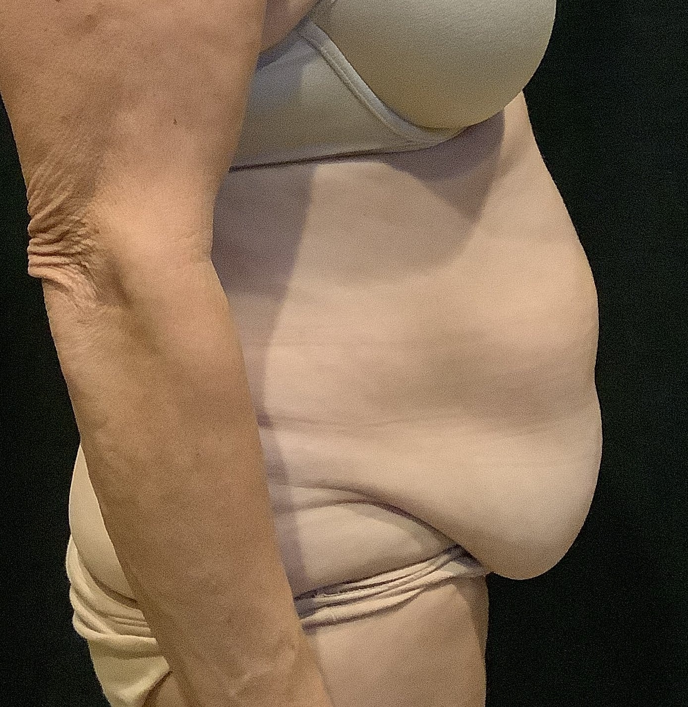 Tummy Tuck Before & After