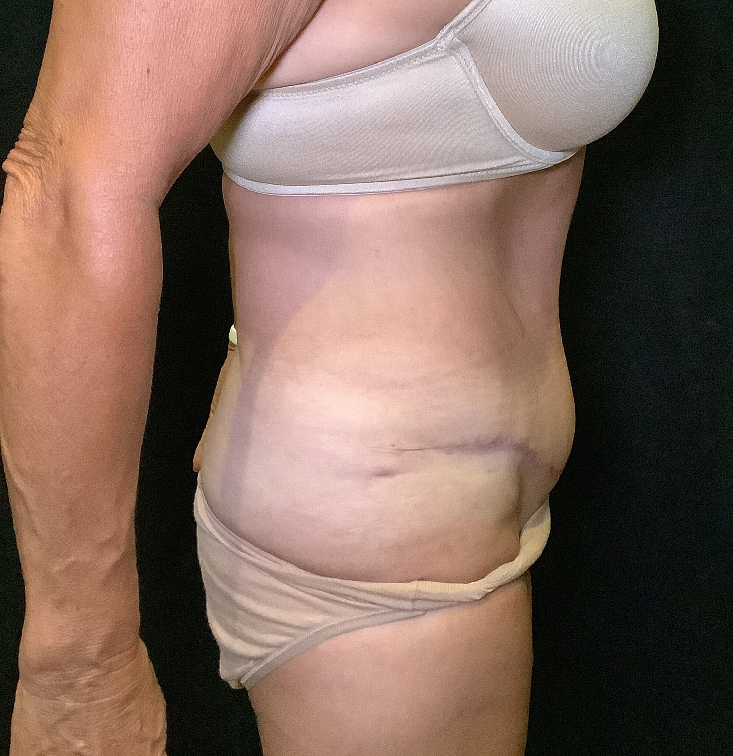 Tummy Tuck Before & After