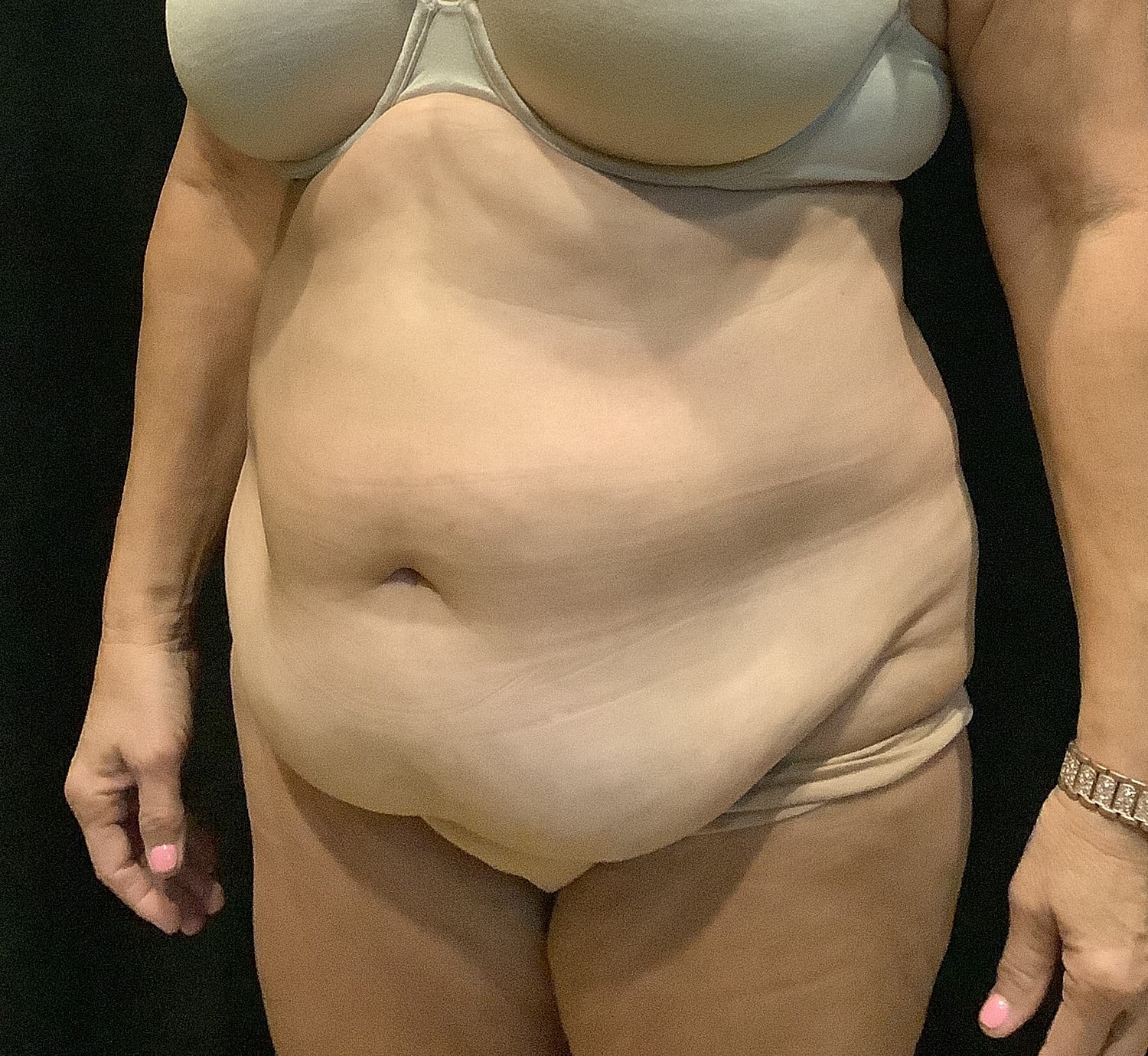 Tummy Tuck Before & After