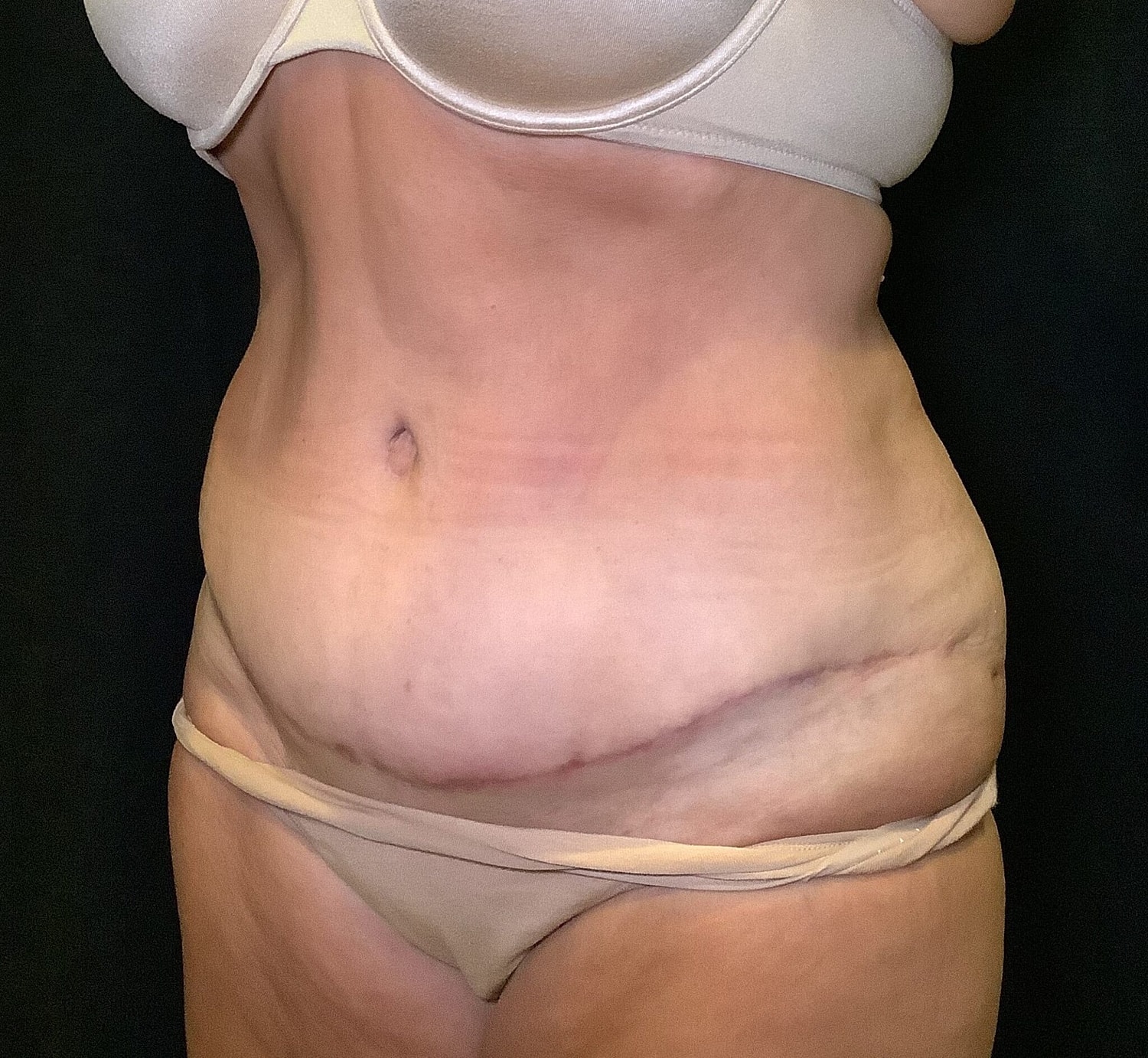 Tummy Tuck Before & After