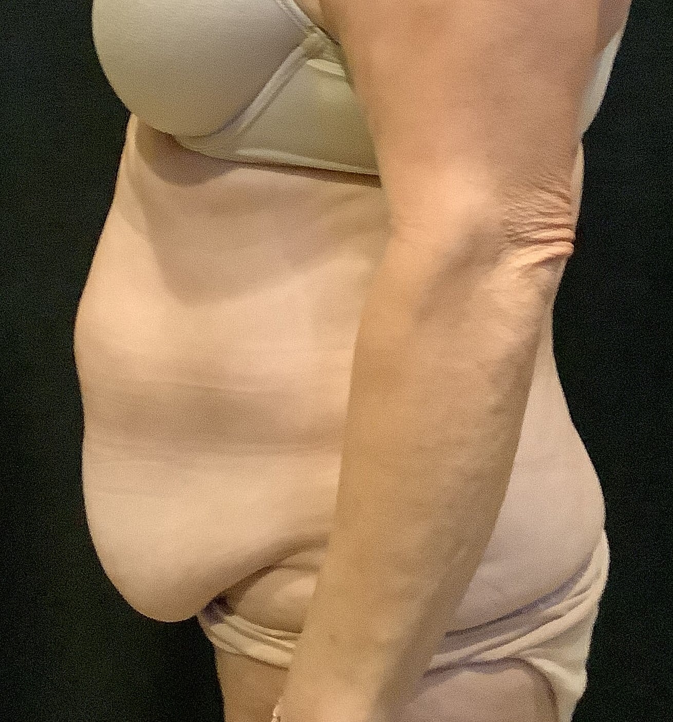Tummy Tuck Before & After