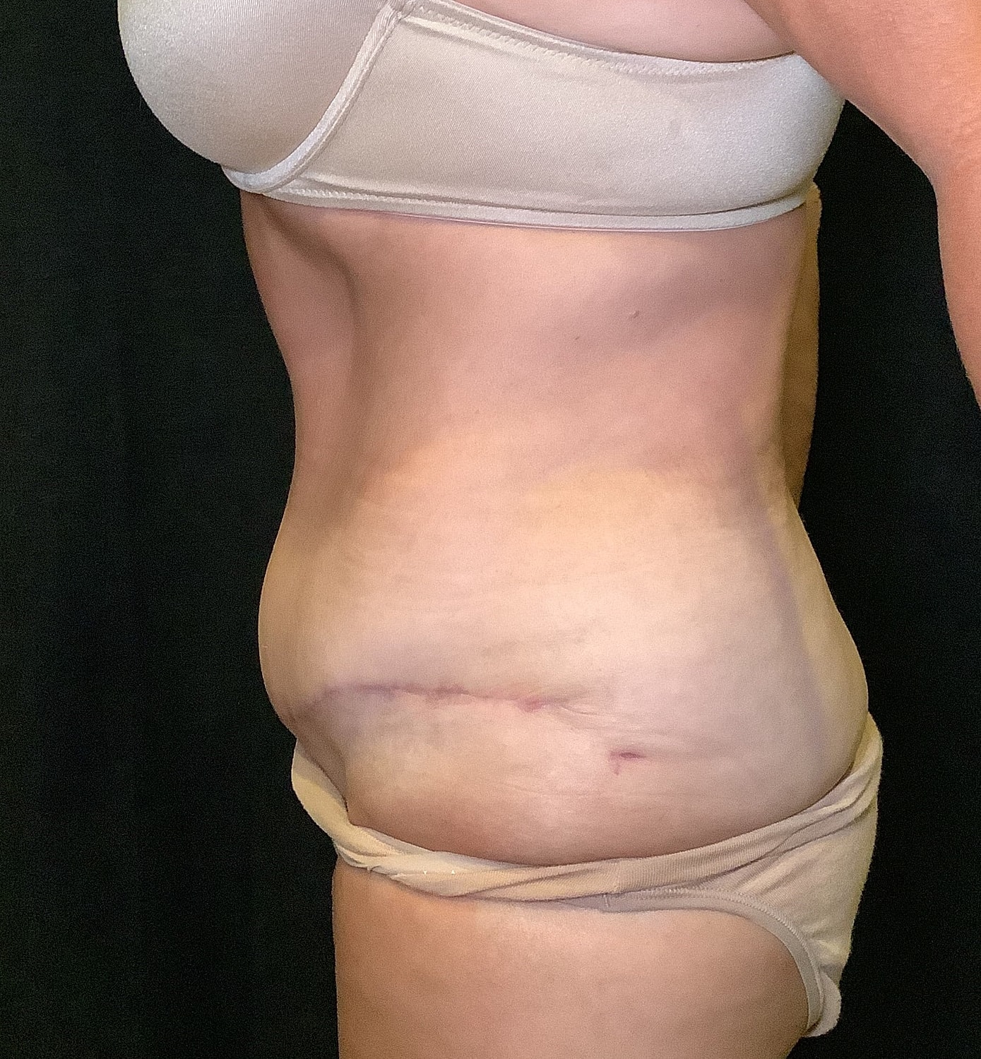 Tummy Tuck Before & After