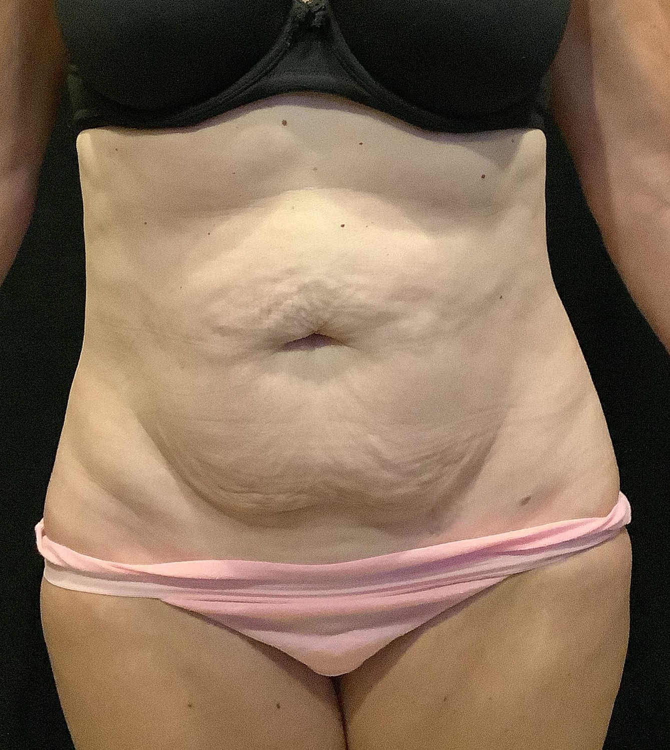 Tummy Tuck Before & After