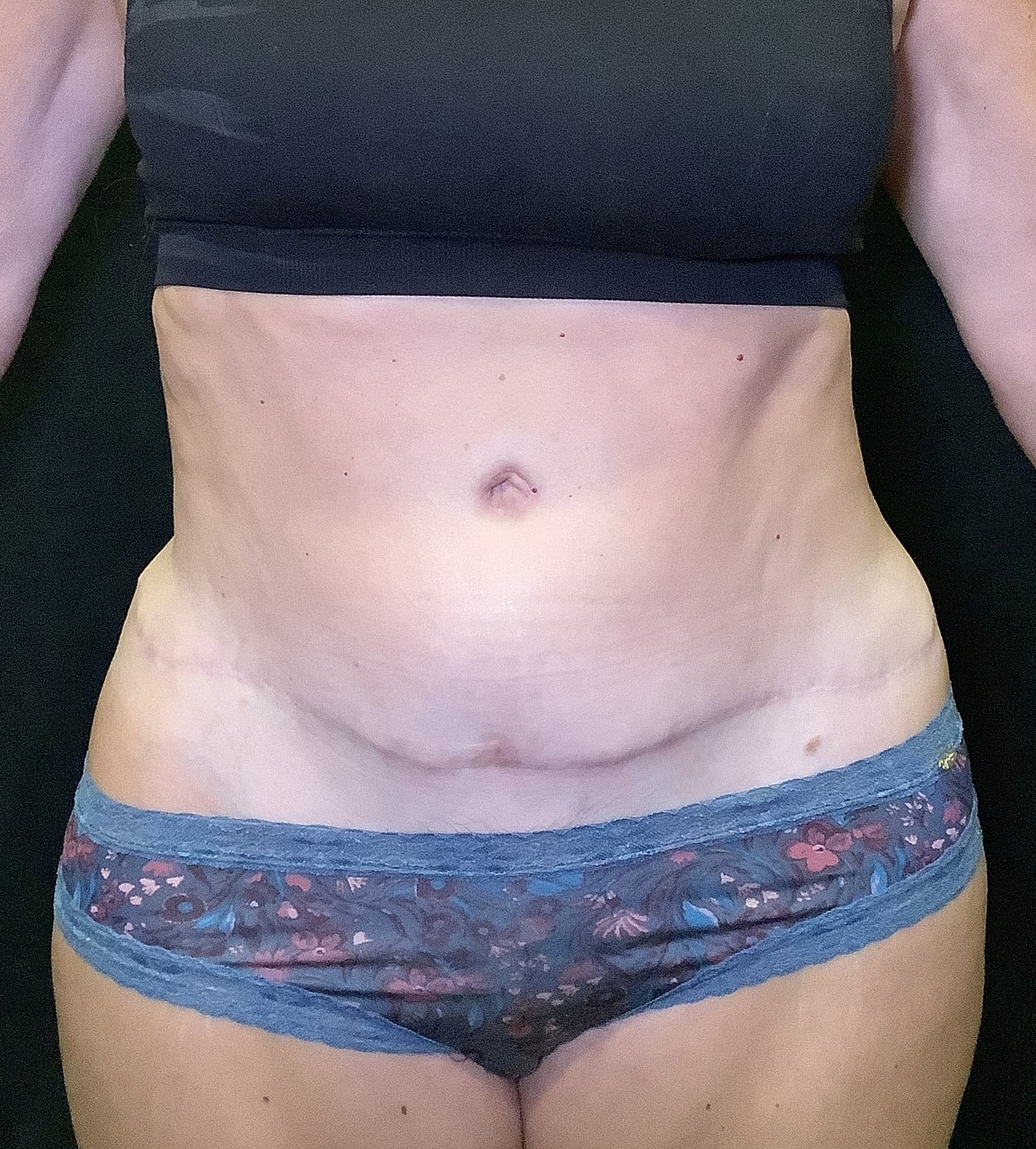 Tummy Tuck Before & After