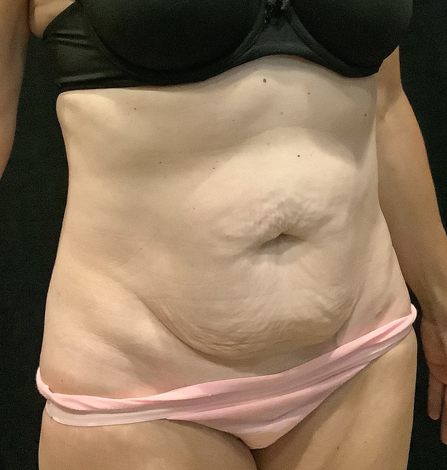 Tummy Tuck Before & After