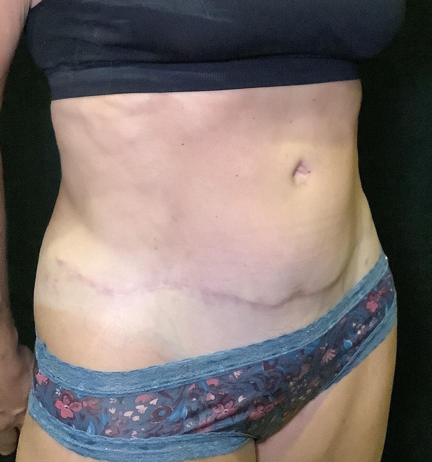 Tummy Tuck Before & After