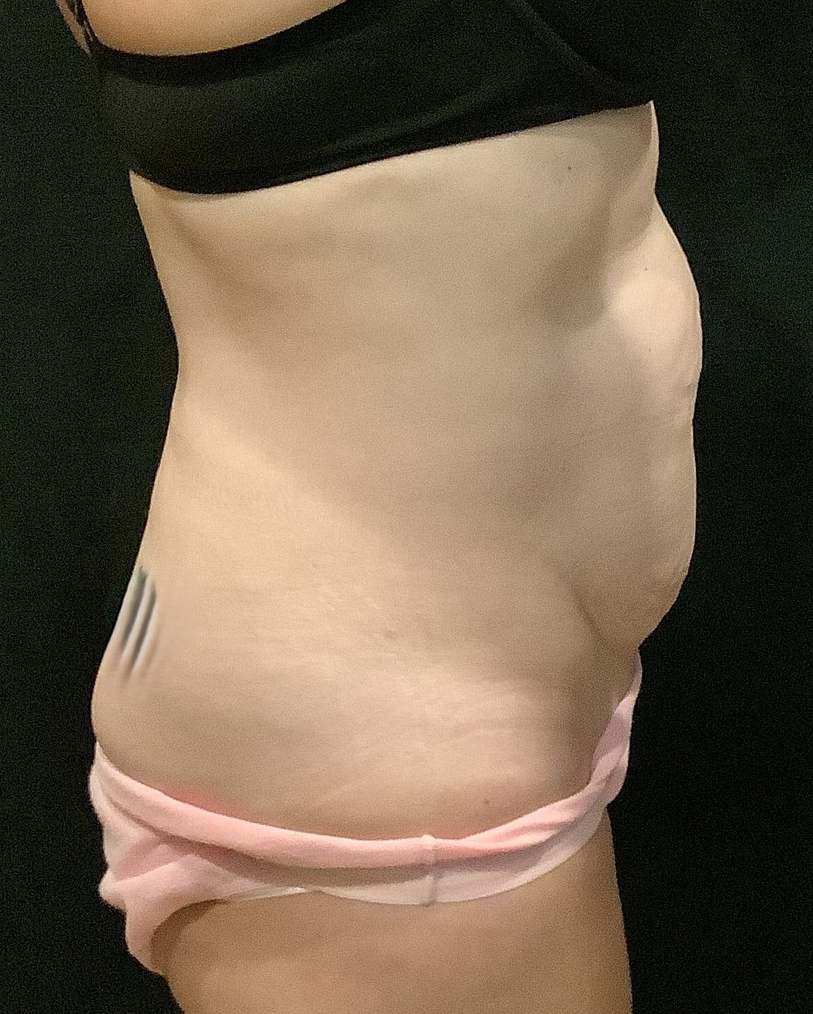 Tummy Tuck Before & After