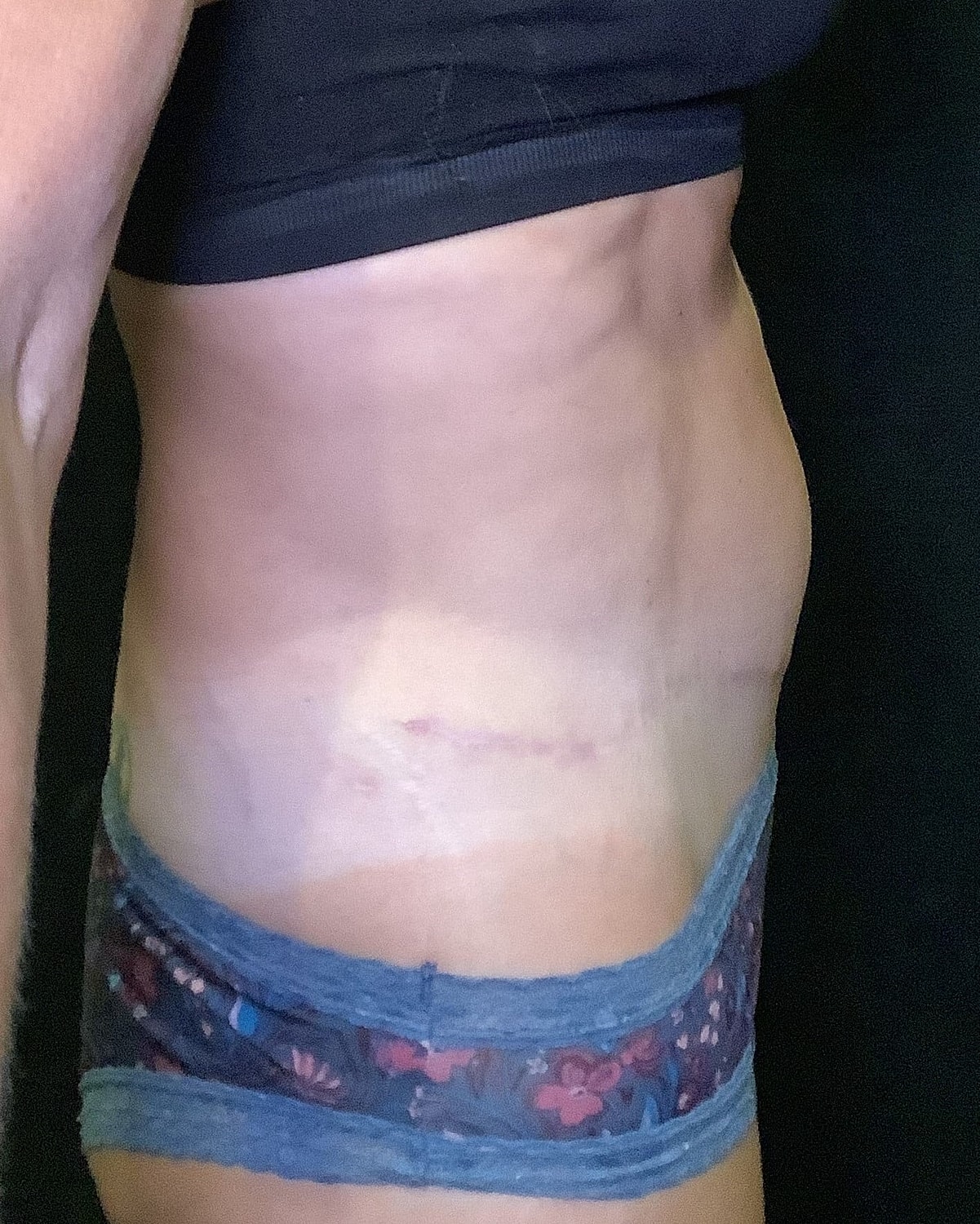 Tummy Tuck Before & After