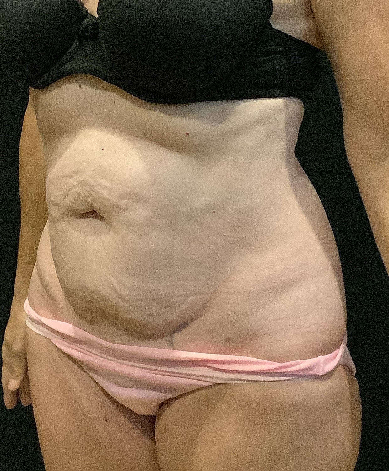 Tummy Tuck Before & After