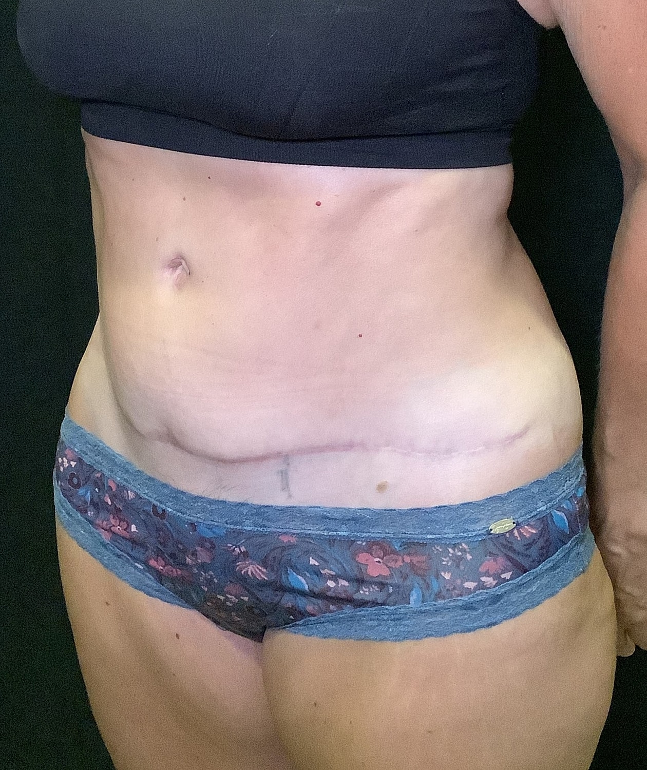 Tummy Tuck Before & After